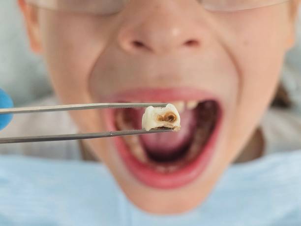 Best Broken or Cracked Tooth Emergency Dentist in Radisson, NY