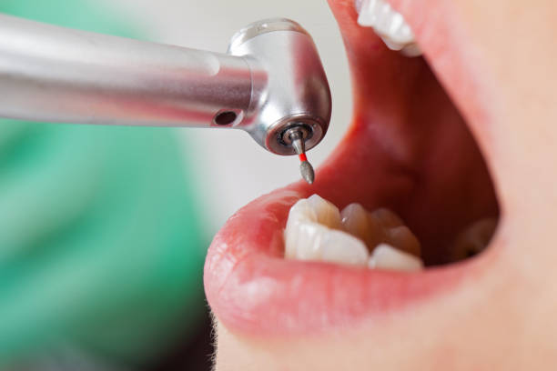 Best Emergency Dentist for Knocked-Out Tooth in Radisson, NY